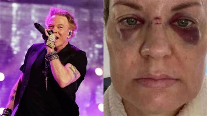Adelaide Woman Claims Injury After Being Struck In The Face By Axl Rose’s Microphone