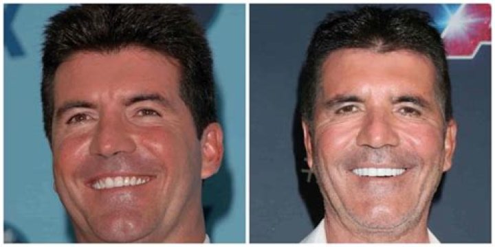 Does Simon Cowell Have Veneers?
